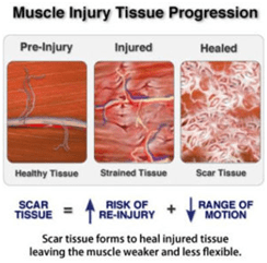 Best way to prevent an Injury, How to avoid Scar Tissue