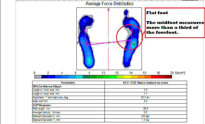 Flat foot Postural Assessment