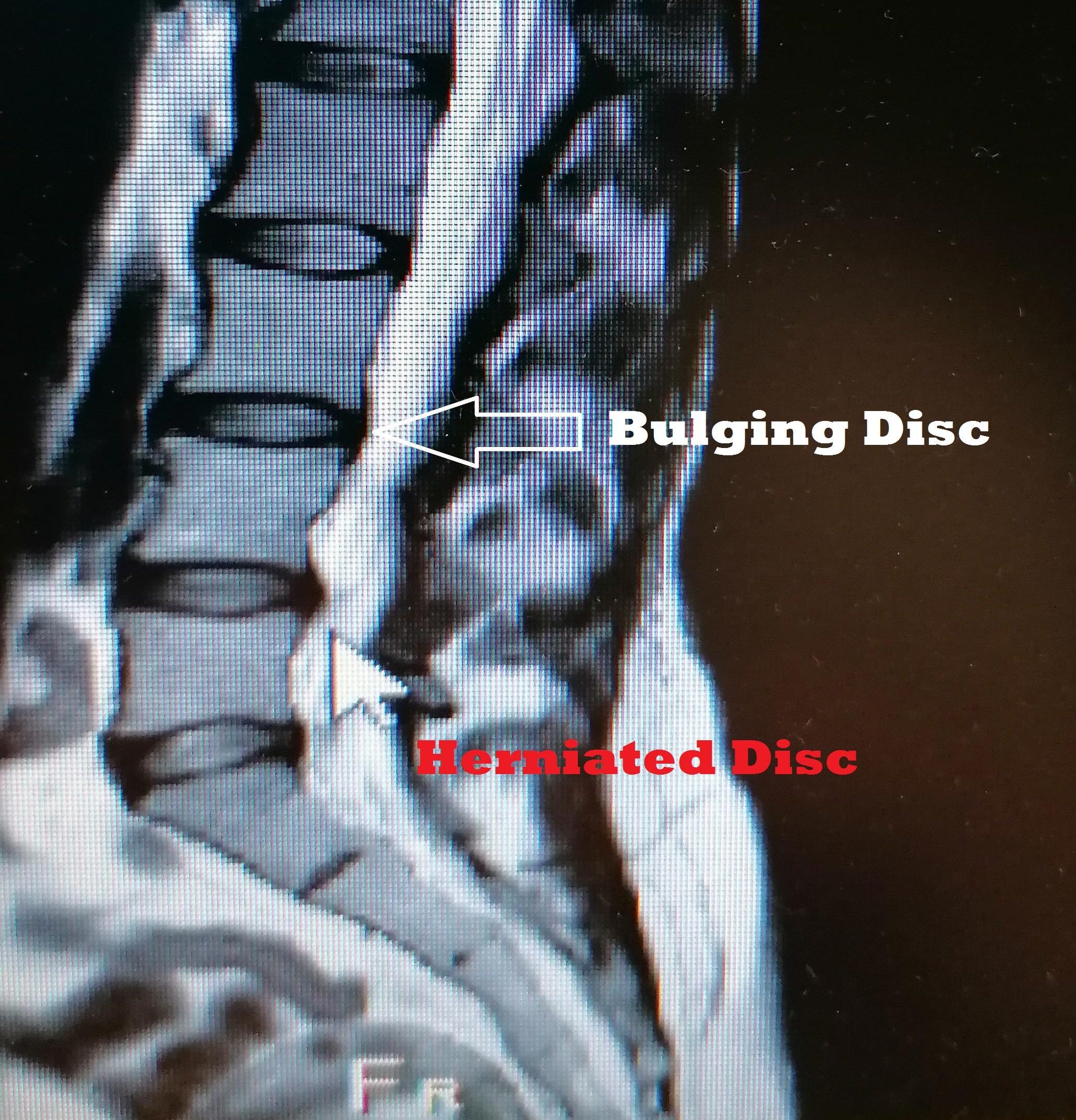 Herniated Disc L4-L5