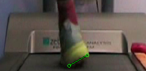 Running Supination-Hight Tech Running Analysis