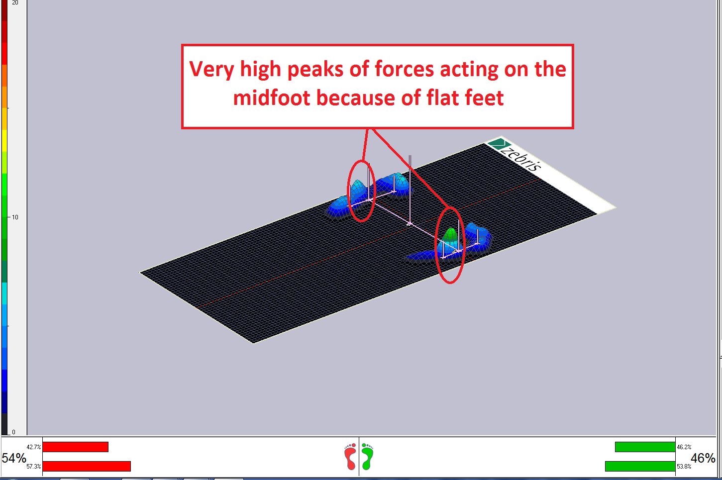 Flat Feet 3D Foot Scan