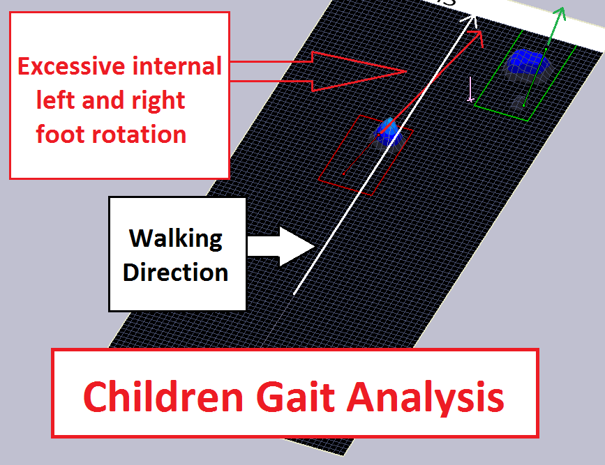 The Best Gait Analysis For Children