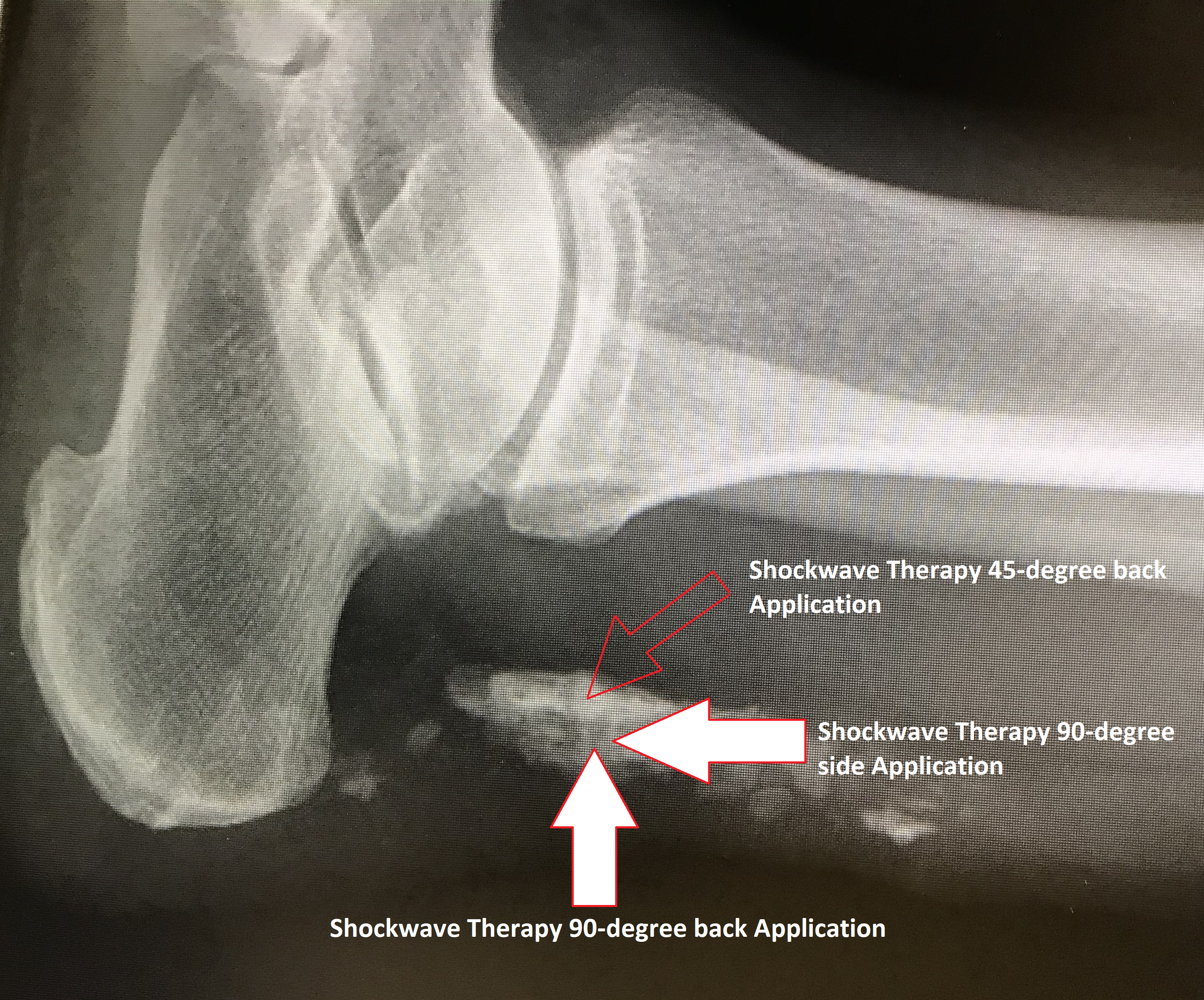 Achilles Cacification Shockwave Therapy Application